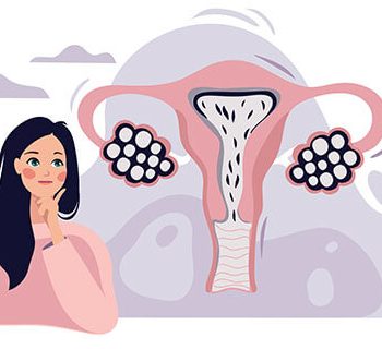 تنبلی تخمدان